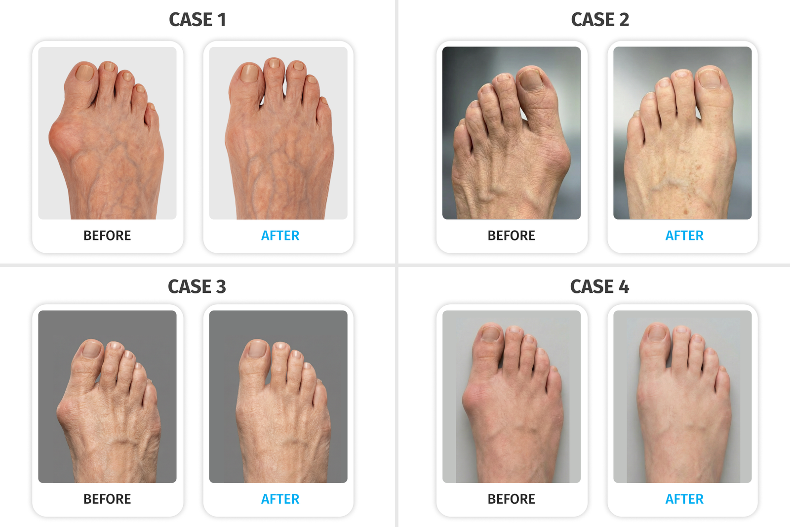 Four before and after bunion cases