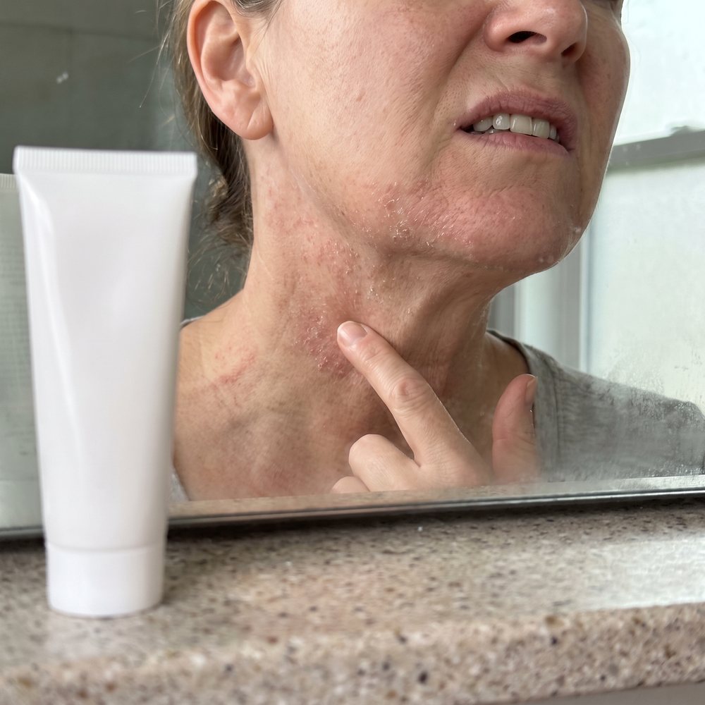 A close-up of a woman touching red, flaky, irritated skin on her neck, a plain cream tube on the counter