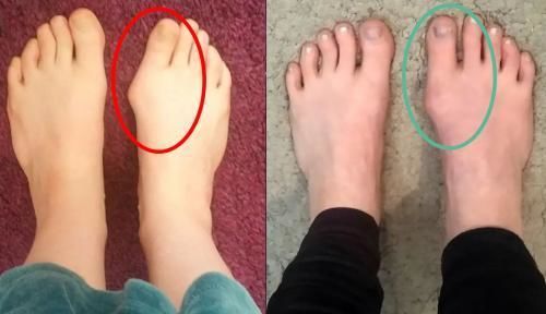 Customer photo of the Avena&trade; Bunion Fix