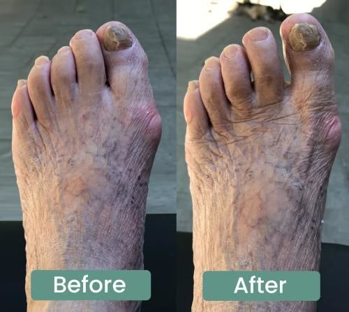 Customer photo of the Avena&trade; Bunion Fix