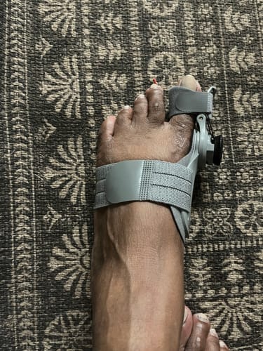 Customer photo of the Avena&trade; Bunion Fix