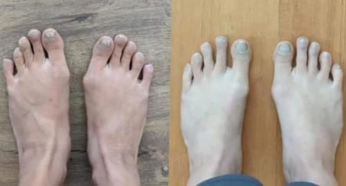 Customer photo of the Avena&trade; Bunion Fix