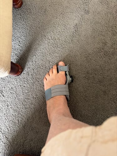 Customer photo of the Avena&trade; Bunion Fix