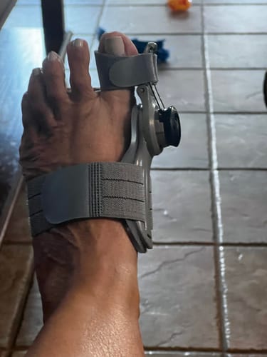 Customer photo of the Avena&trade; Bunion Fix
