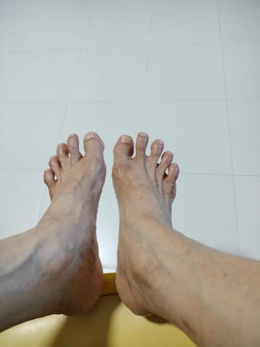 Customer photo of the Avena&trade; Bunion Fix