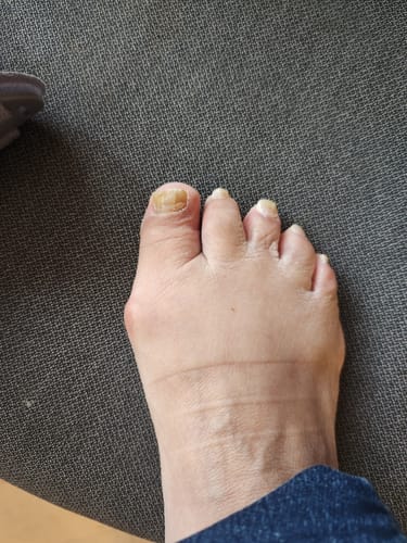 Customer photo of the Avena&trade; Bunion Fix