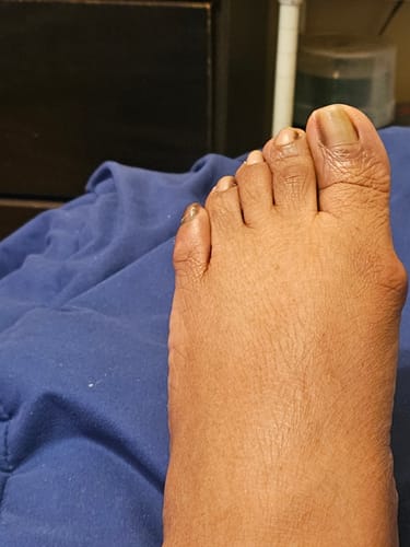 Customer photo of the Avena&trade; Bunion Fix