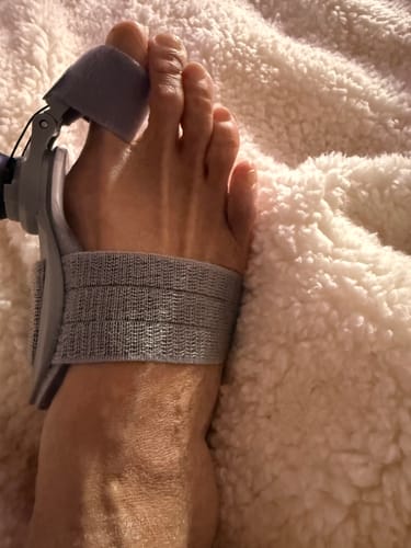 Customer photo of the Avena&trade; Bunion Fix