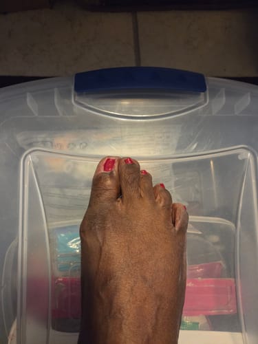 Customer photo of the Avena&trade; Bunion Fix